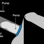 Wat is het Verschil Tussen een Penispomp en een Penisring?